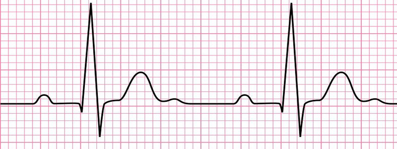 Electrocardiogram (ECG): working principle, normal ECG wave