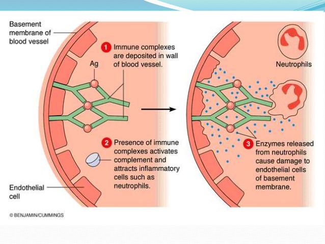 Type III hypersensitivity reaction: factors causing immune complex