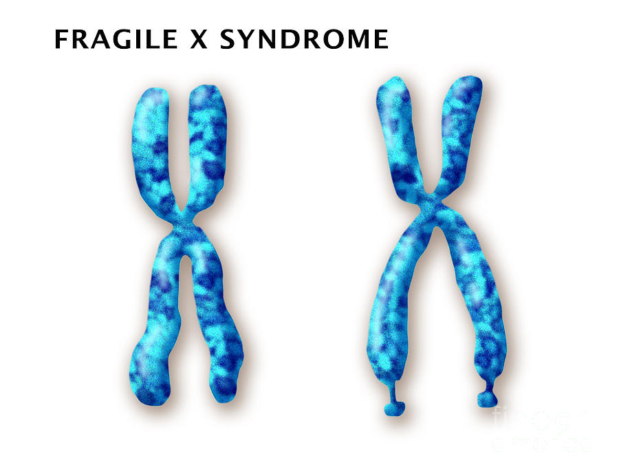 Fragile X Syndrome Dna