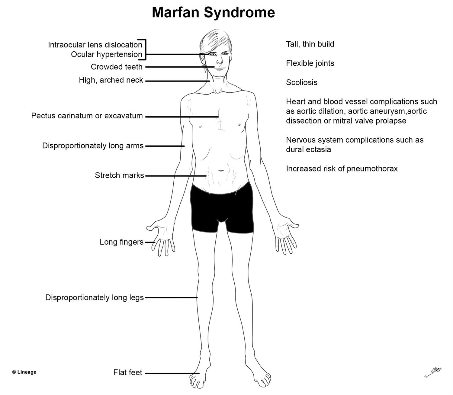 O Que é Síndrome De Marfan - EDUBRAINAZ